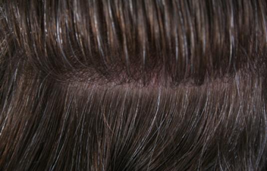 Hair Transplant&nbsp;Trichophytic Donor Scars